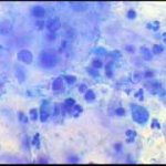 Αδενικών κυτταρων στο Pap-test